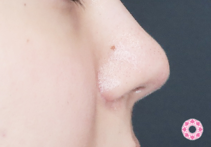 年代：20代 施術名：小鼻縮小 施術後｜【公式】東京形成美容外科