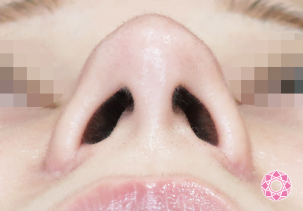 年代：20代 施術名：小鼻縮小 施術後｜【公式】東京形成美容外科