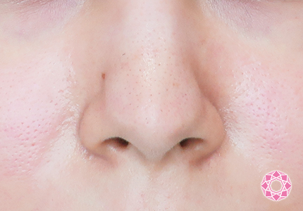 年代：20代 施術名：小鼻縮小 施術前｜【公式】東京形成美容外科