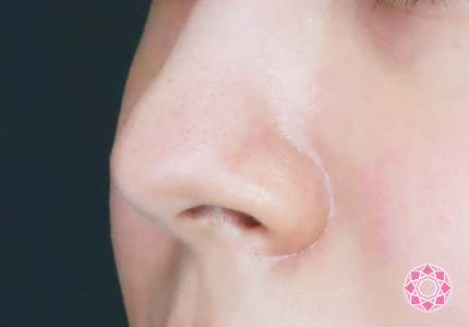 年代：20代 施術名：小鼻縮小 施術前｜【公式】東京形成美容外科