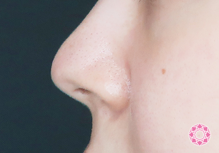 年代：20代 施術名：小鼻縮小 施術前｜【公式】東京形成美容外科