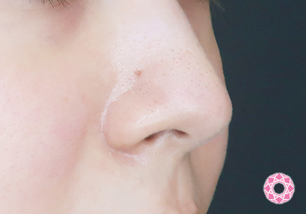 年代：20代 施術名：小鼻縮小 施術前｜【公式】東京形成美容外科