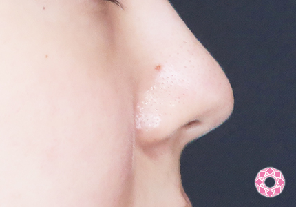 年代：20代 施術名：小鼻縮小 施術前｜【公式】東京形成美容外科