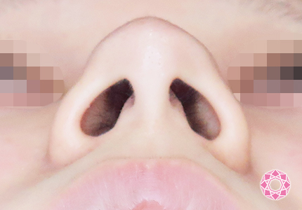 年代：20代 施術名：小鼻縮小 施術前｜【公式】東京形成美容外科