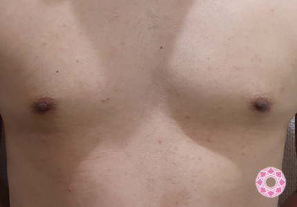 年代：20代 施術名：乳頭縮小・乳頭縮小（乳管温存法） 施術後｜【公式】東京形成美容外科