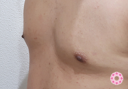 年代：20代 施術名：乳頭縮小・乳頭縮小（乳管温存法） 施術後｜【公式】東京形成美容外科