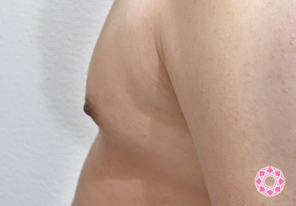 年代：20代 施術名：乳頭縮小・乳頭縮小（乳管温存法） 施術後｜【公式】東京形成美容外科