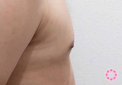 年代：20代 施術名：乳頭縮小・乳頭縮小（乳管温存法） 施術後｜【公式】東京形成美容外科