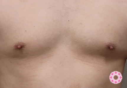 年代：20代 施術名：乳頭縮小・乳頭縮小（乳管温存法） 施術前｜【公式】東京形成美容外科