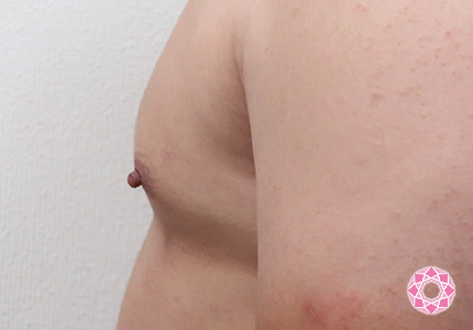 年代：20代 施術名：乳頭縮小・乳頭縮小（乳管温存法） 施術前｜【公式】東京形成美容外科