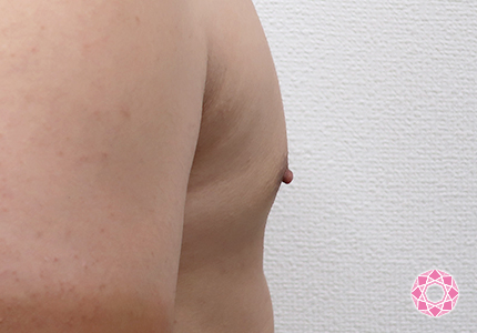 年代：20代 施術名：乳頭縮小・乳頭縮小（乳管温存法） 施術前｜【公式】東京形成美容外科