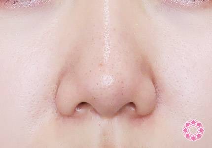 年代：20代 施術名：小鼻縮小 施術後｜【公式】東京形成美容外科