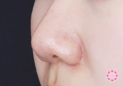 年代：20代 施術名：小鼻縮小 施術後｜【公式】東京形成美容外科