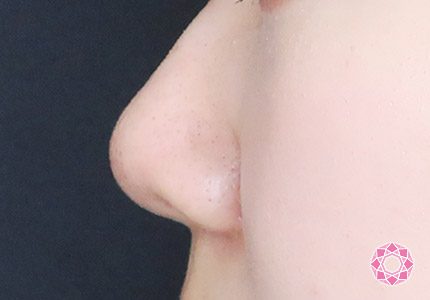 年代：20代 施術名：小鼻縮小 施術後｜【公式】東京形成美容外科