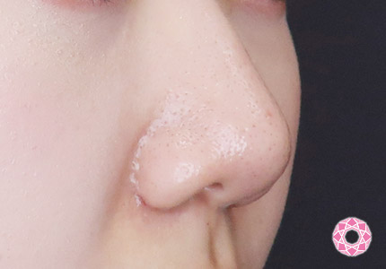 年代：20代 施術名：小鼻縮小 施術後｜【公式】東京形成美容外科