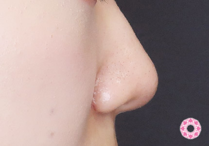 年代：20代 施術名：小鼻縮小 施術後｜【公式】東京形成美容外科