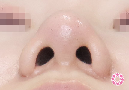 年代：20代 施術名：小鼻縮小 施術後｜【公式】東京形成美容外科