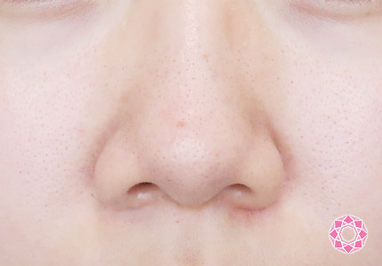 年代：20代 施術名：小鼻縮小 施術前｜【公式】東京形成美容外科