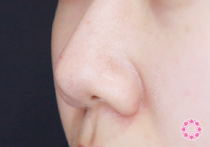 年代：20代 施術名：小鼻縮小 施術前｜【公式】東京形成美容外科