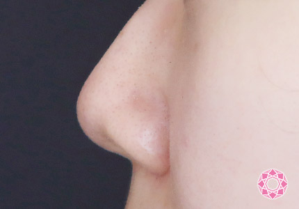 年代：20代 施術名：小鼻縮小 施術前｜【公式】東京形成美容外科