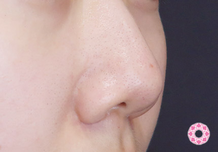 年代：20代 施術名：小鼻縮小 施術前｜【公式】東京形成美容外科