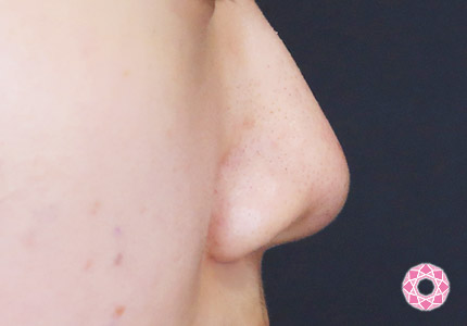 年代：20代 施術名：小鼻縮小 施術前｜【公式】東京形成美容外科