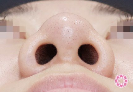 年代：20代 施術名：小鼻縮小 施術前｜【公式】東京形成美容外科