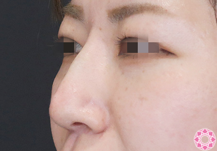年代：30代 施術名：プチ隆鼻術（ヒアルロン酸） 施術後｜【公式】東京形成美容外科