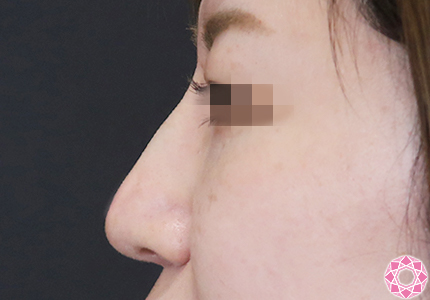 年代：30代 施術名：プチ隆鼻術（ヒアルロン酸） 施術後｜【公式】東京形成美容外科