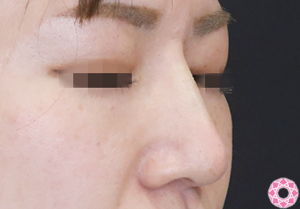 年代：30代 施術名：プチ隆鼻術（ヒアルロン酸） 施術後｜【公式】東京形成美容外科