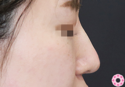 年代：30代 施術名：プチ隆鼻術（ヒアルロン酸） 施術後｜【公式】東京形成美容外科