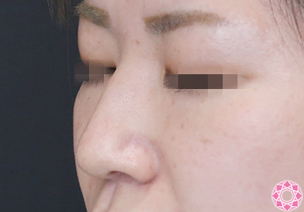 年代：30代 施術名：プチ隆鼻術（ヒアルロン酸） 施術前｜【公式】東京形成美容外科