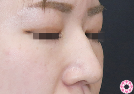 年代：30代 施術名：プチ隆鼻術（ヒアルロン酸） 施術前｜【公式】東京形成美容外科
