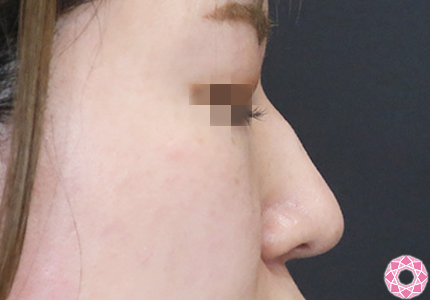 年代：30代 施術名：プチ隆鼻術（ヒアルロン酸） 施術前｜【公式】東京形成美容外科