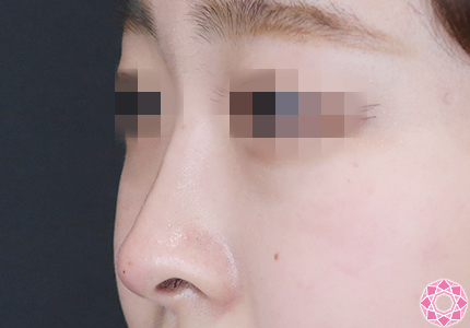 年代：20代 施術名：プチ隆鼻術（ヒアルロン酸） 施術後｜【公式】東京形成美容外科
