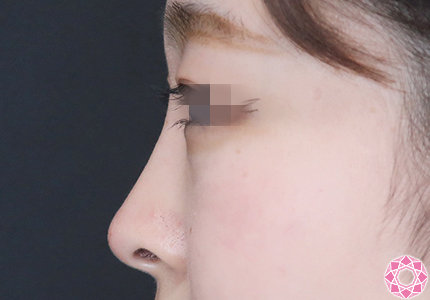 年代：20代 施術名：プチ隆鼻術（ヒアルロン酸） 施術後｜【公式】東京形成美容外科