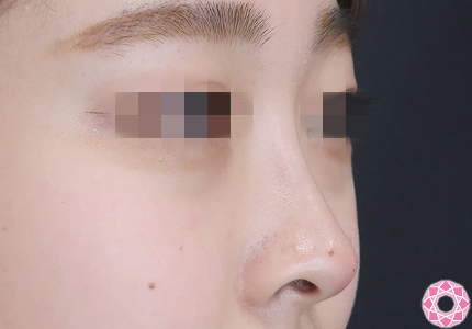 年代：20代 施術名：プチ隆鼻術（ヒアルロン酸） 施術後｜【公式】東京形成美容外科