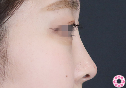 年代：20代 施術名：プチ隆鼻術（ヒアルロン酸） 施術後｜【公式】東京形成美容外科