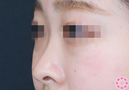 年代：20代 施術名：プチ隆鼻術（ヒアルロン酸） 施術前｜【公式】東京形成美容外科