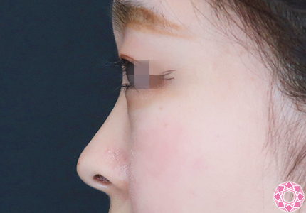年代：20代 施術名：プチ隆鼻術（ヒアルロン酸） 施術前｜【公式】東京形成美容外科