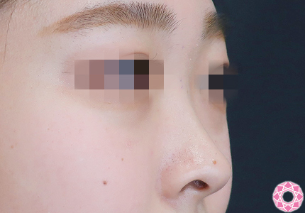 年代：20代 施術名：プチ隆鼻術（ヒアルロン酸） 施術前｜【公式】東京形成美容外科