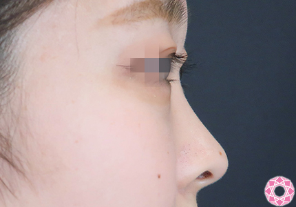 年代：20代 施術名：プチ隆鼻術（ヒアルロン酸） 施術前｜【公式】東京形成美容外科