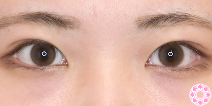 年代：20代 施術名：二重埋没法 施術後｜【公式】東京形成美容外科