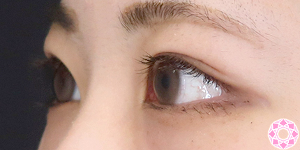 年代：20代 施術名：二重埋没法 施術後｜【公式】東京形成美容外科