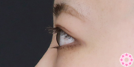 年代：20代 施術名：二重埋没法 施術後｜【公式】東京形成美容外科