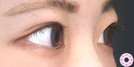 年代：20代 施術名：二重埋没法 施術後｜【公式】東京形成美容外科