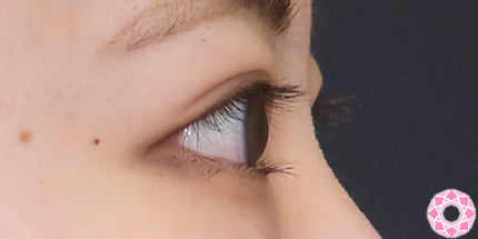 年代：20代 施術名：二重埋没法 施術後｜【公式】東京形成美容外科