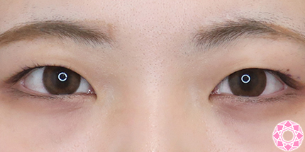 年代：20代 施術名：二重埋没法 施術前｜【公式】東京形成美容外科