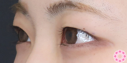 年代：20代 施術名：二重埋没法 施術前｜【公式】東京形成美容外科