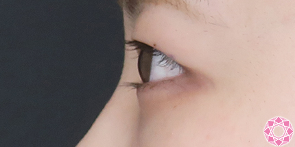 年代：20代 施術名：二重埋没法 施術前｜【公式】東京形成美容外科